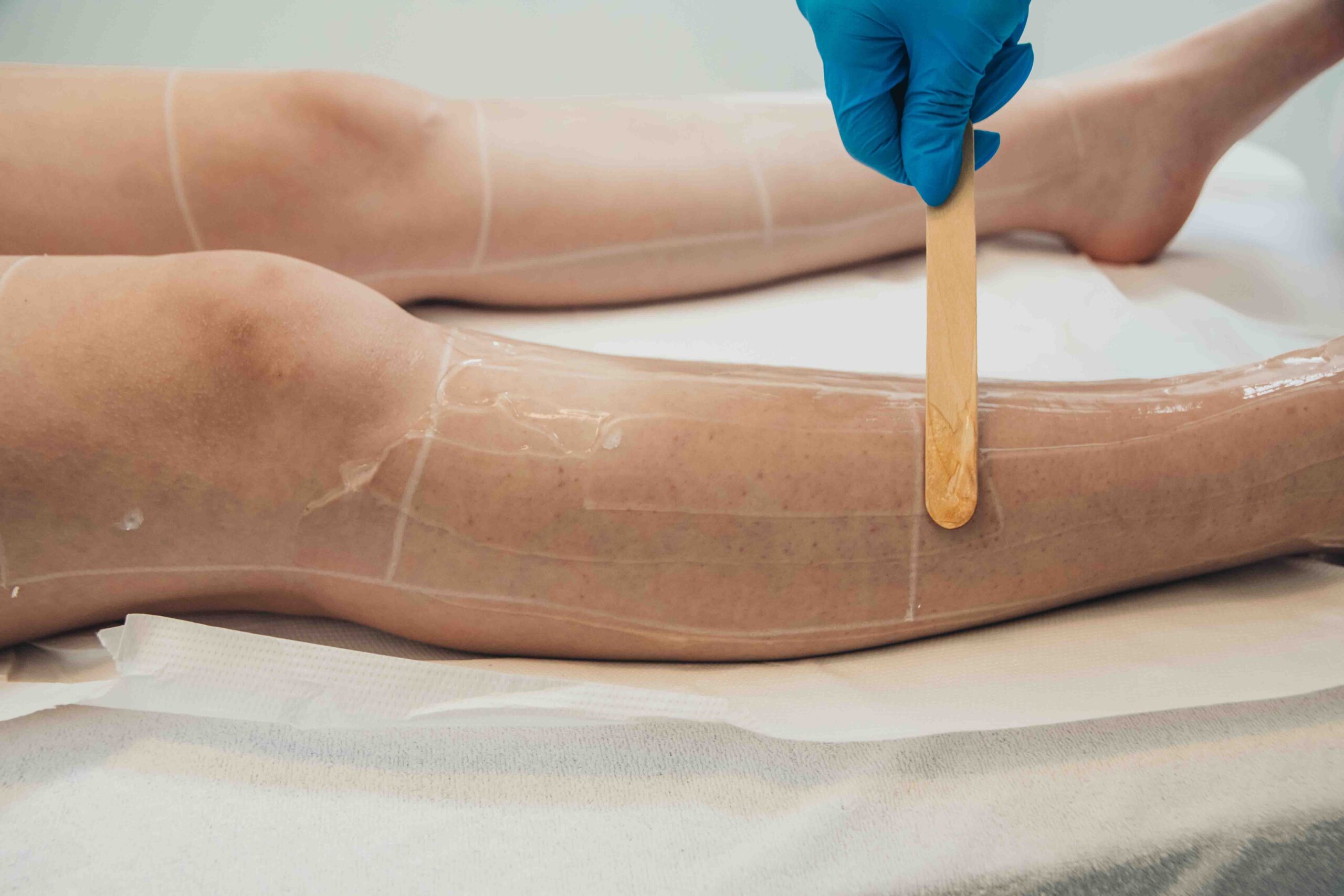 Aplicarea gelului protecto-conductor in cadrul sedintei de epilare definitiva cu laser la episculpt beauty sibiu