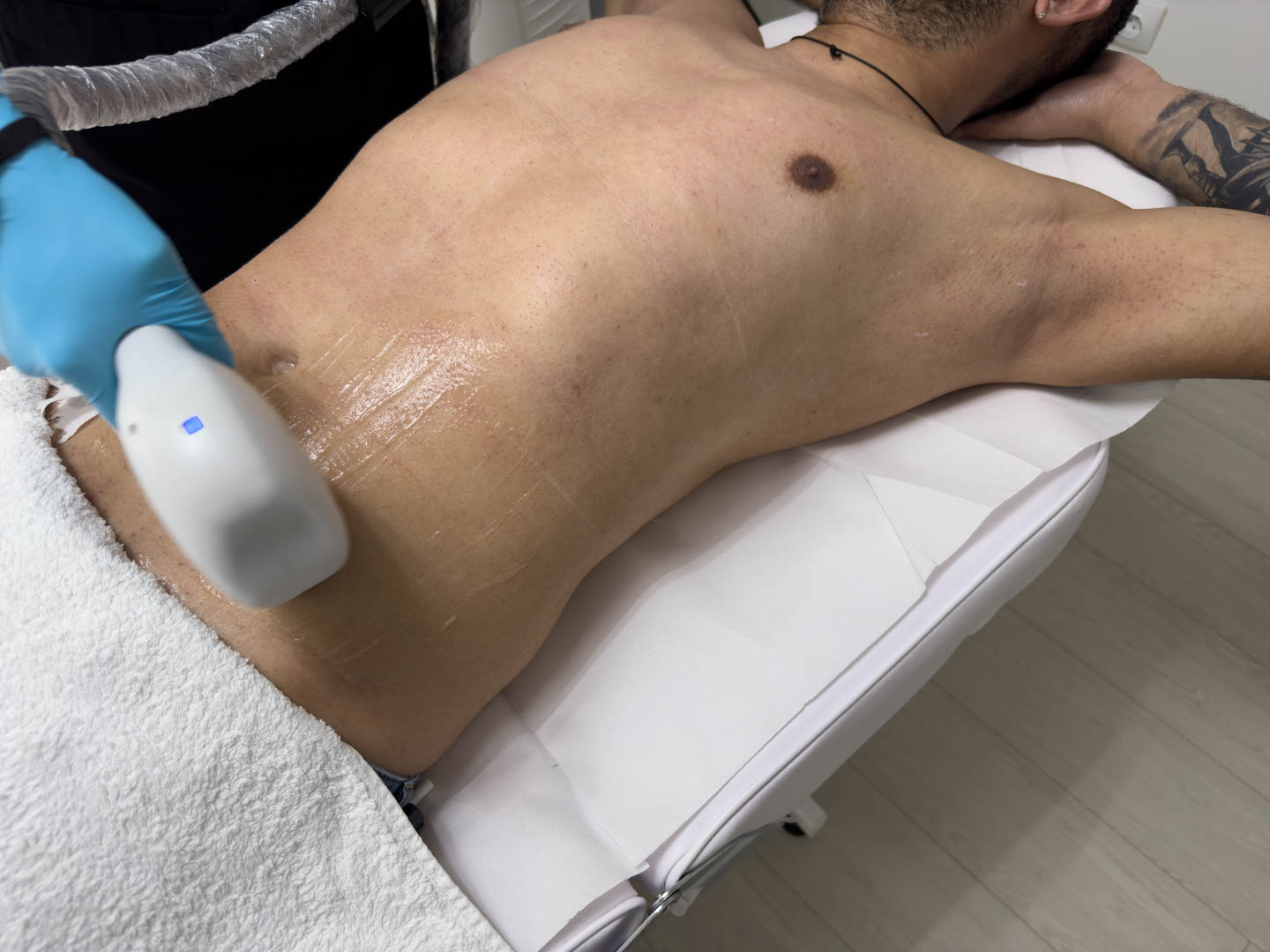 sedinta de epilare definitiva cu laser dioda pentru barbati zona abdomen