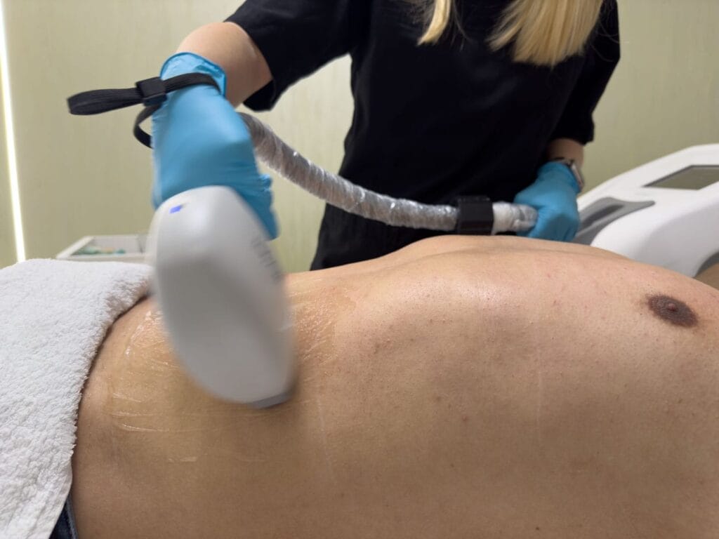 sedinta de epilare definitiva cu laser la episculpt beauty sibiu