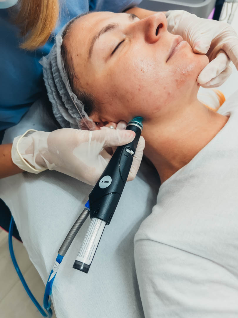 prin intermediul hidrodermabraziunii hydrafacial efectuam tratamente de curatare pentru puncte negre, pori dilatati, peeling chimic cu singurul Syndeo din Sibiu