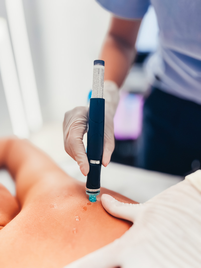 Cu ajutorul Hydrafacial Syndeo la Episculpt Beauty Sibiu efectuam si tratamente de curatare corporala