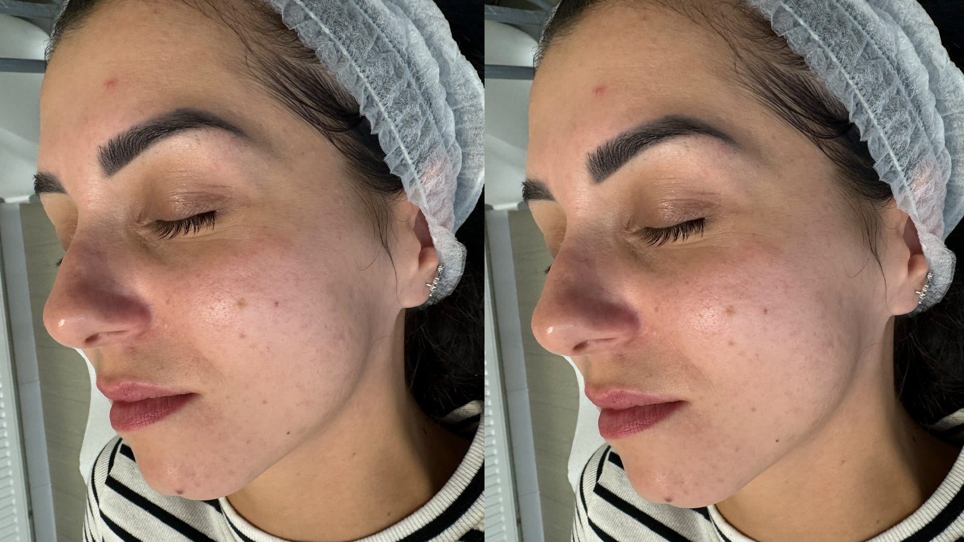 rezultate before and after pentru reducerea porilor si curatarea punctelor negre la episculpt beauty sibiu