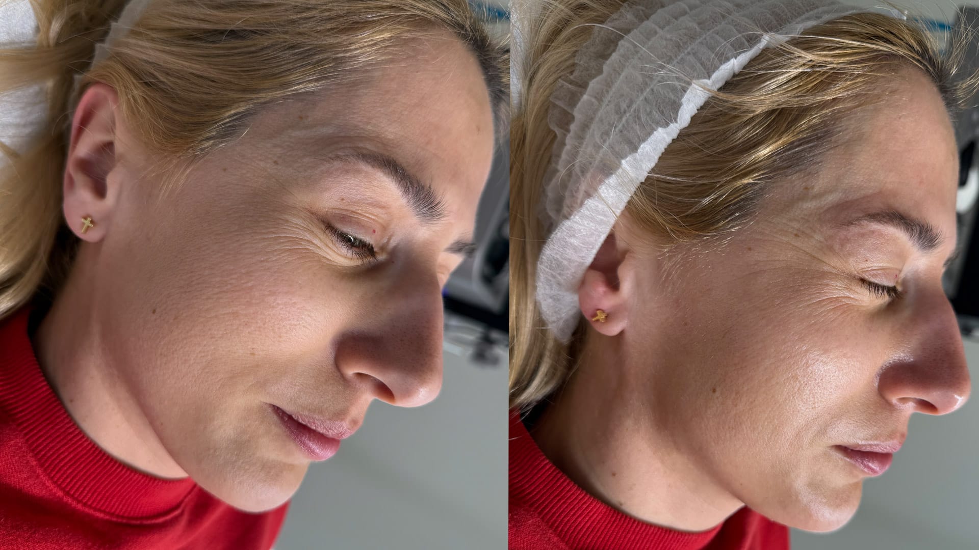 rezultat dupa tratamentul facial cu Hydrafacial Syndeo la Episculpt Beauty Sibiu