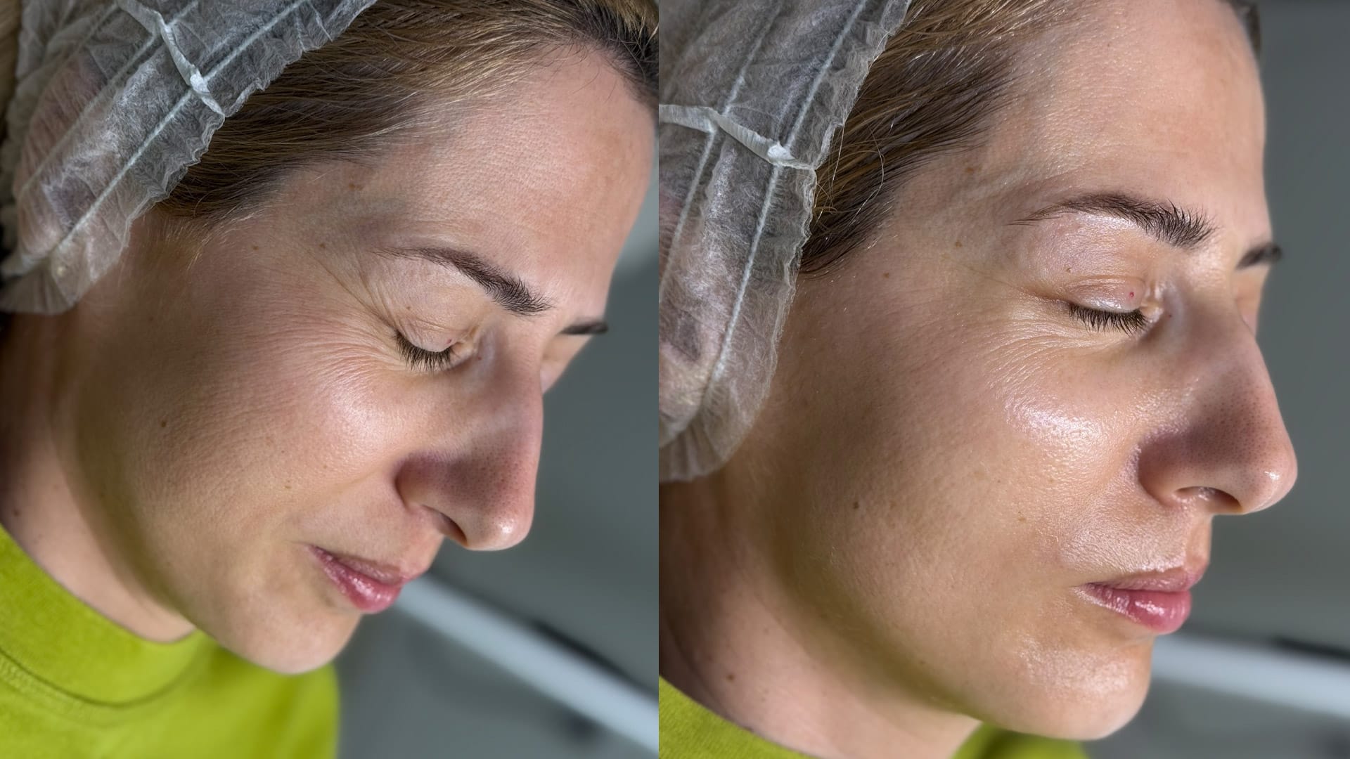 rezultat before and after dupa tratamentul pentru reducerea ridurilor fine, luminozitate de la Intraceuticals