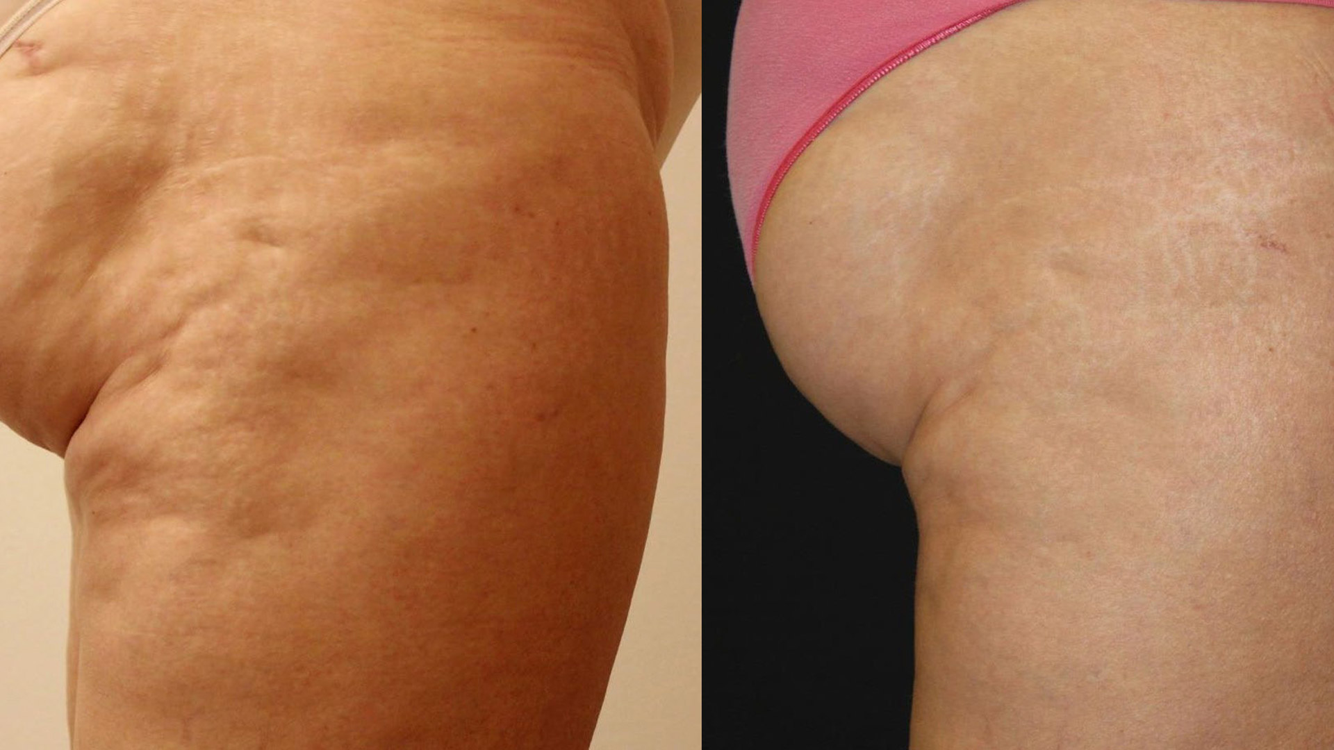 rezultat before and after dupa aplicare tratament celulita prin radiofrecventa multipolara cu viora v10 la episculpt beauty sibiu