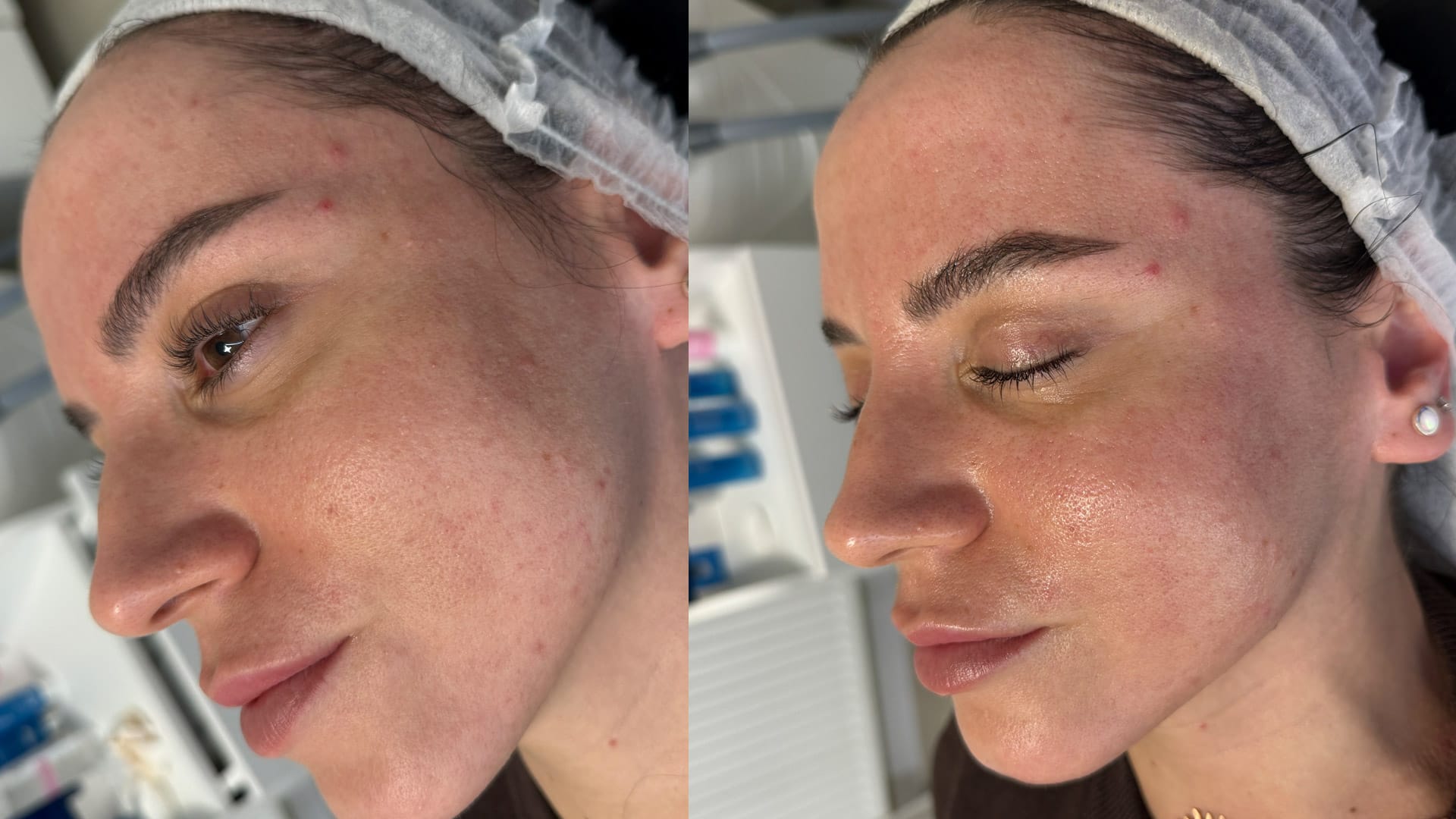 rezultate tratament de curatare faciala cu Hydrafacial la Episculpt Beauty Sibiu