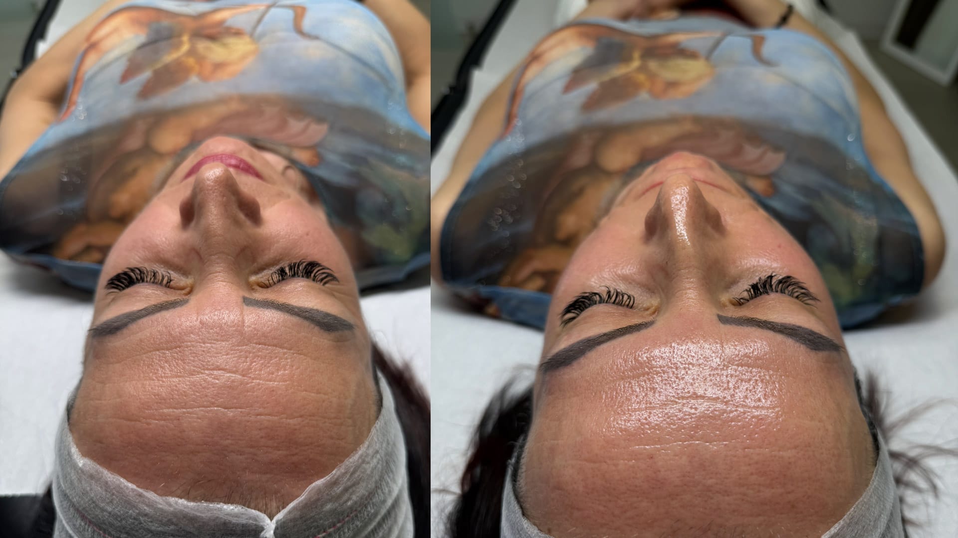 rezultat dupa o sedinta de curatare faciala si hydratare, rezultatele sunt vizibile usoara reducere a ridurilor, curatarea porilor, sebuumului si impuritatilor existente pe ten