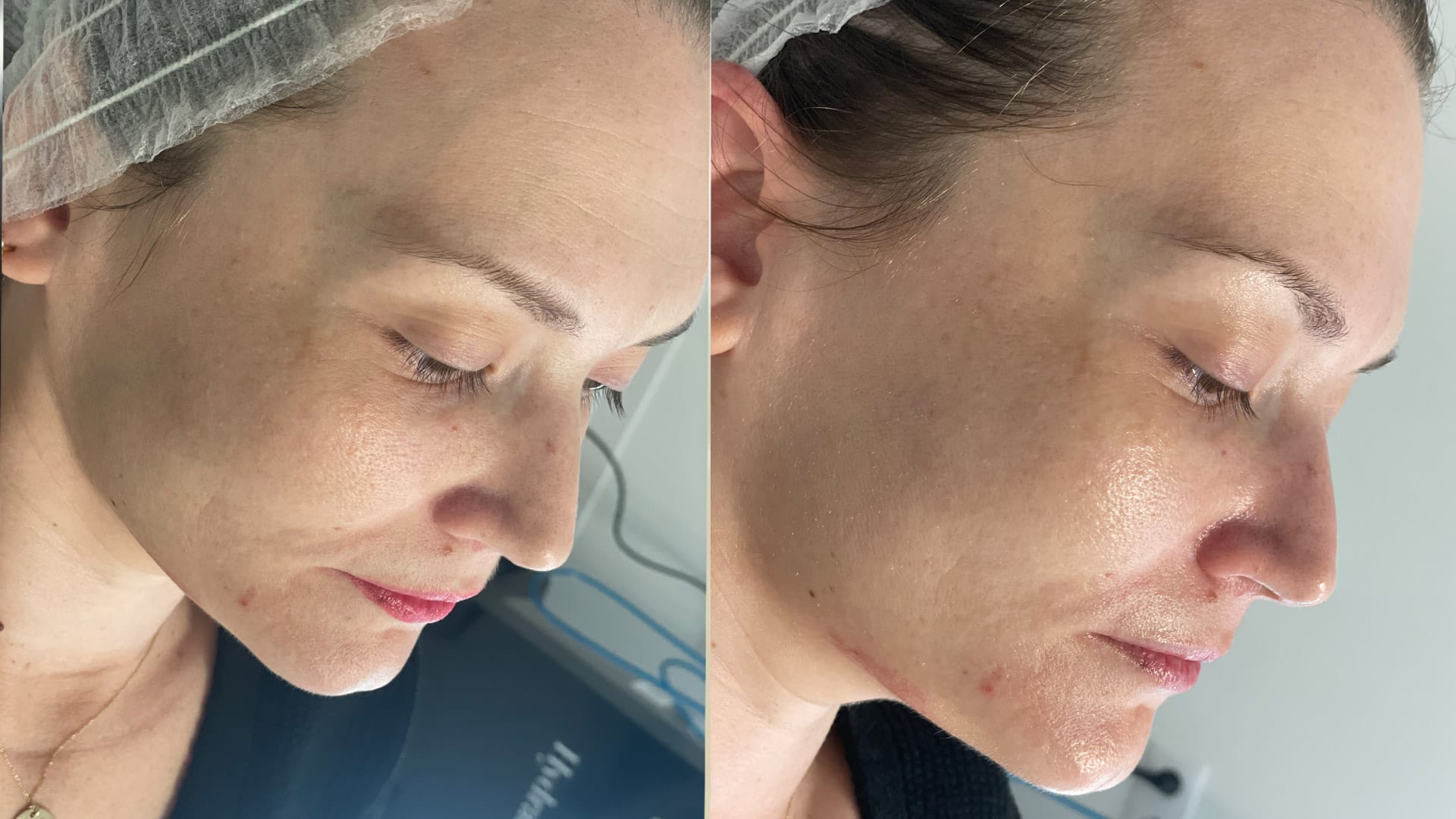 rezultat before and after pentru reducerea porilor dilatati la episculpt beauty cu ajutorul hidrodermabraziunii hydrafacial si oxigen hiperbaric de la intraceuticals