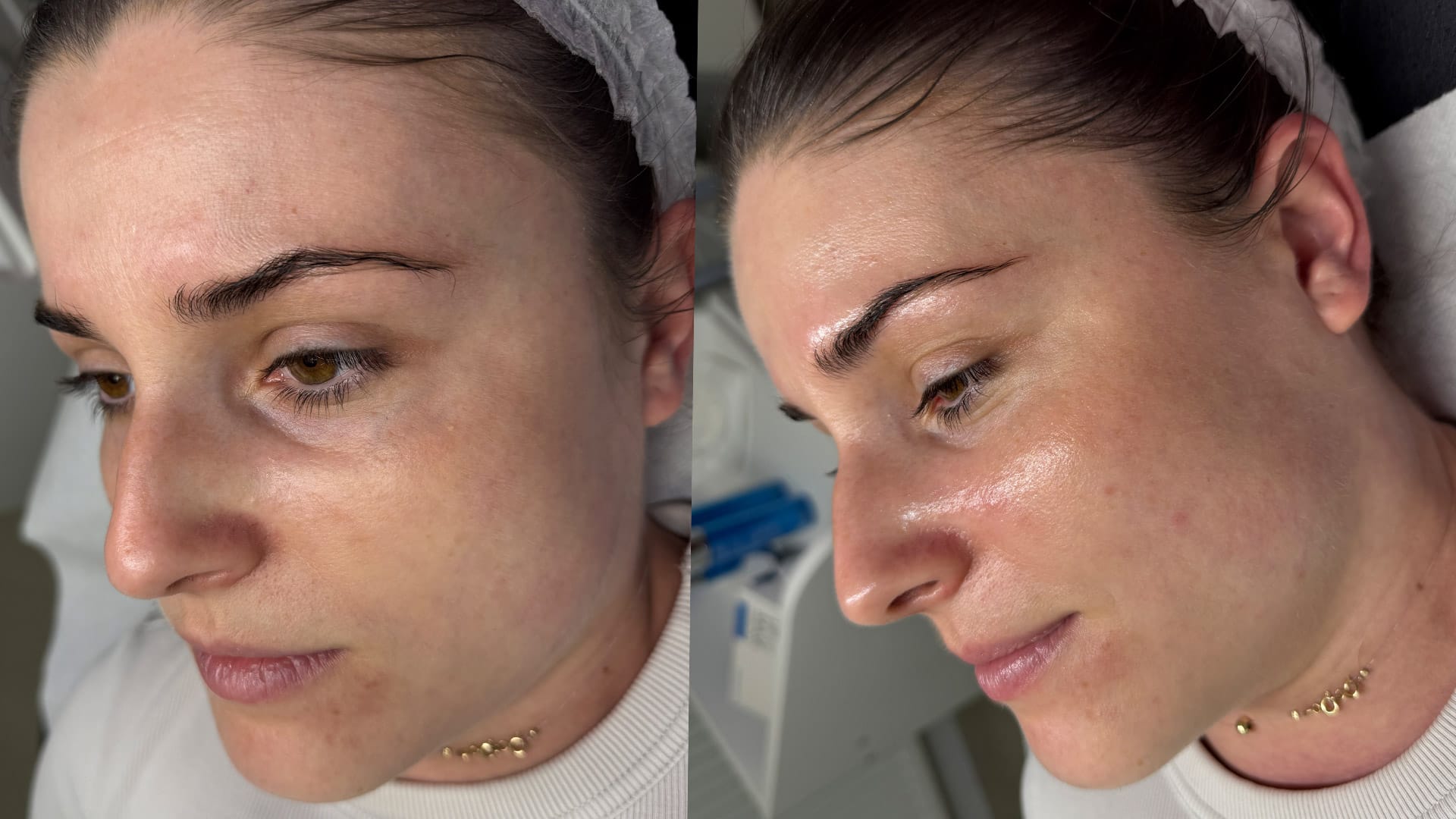 rezultat dupa tratamentul de curatare cu Hydrafacial la Episculpt Beauty Sibiu