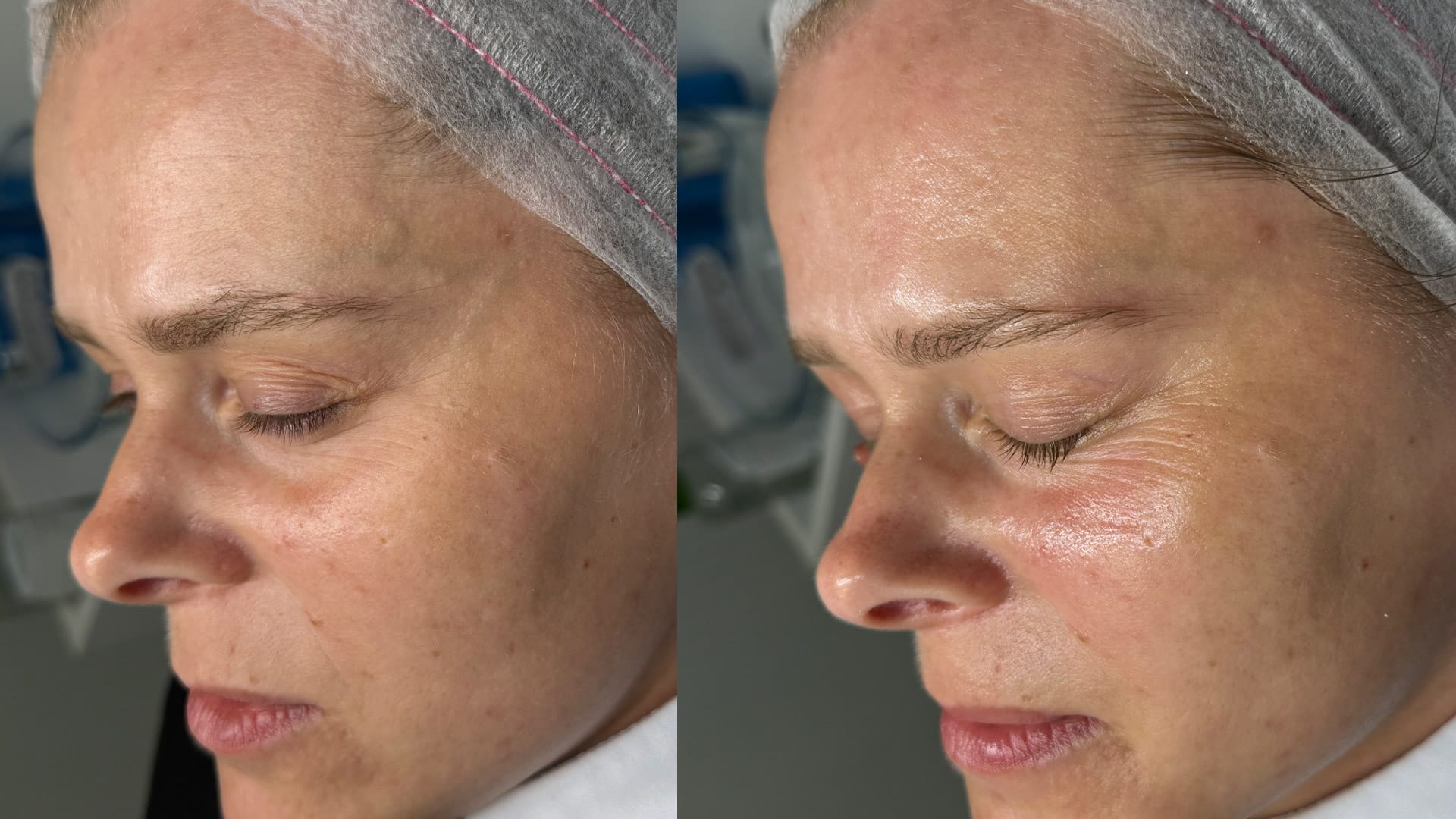 rezultate dupa tratament cu oxigen hiperbaric de la Intraceuticals pentru reducerea ridurilor si luminozitate