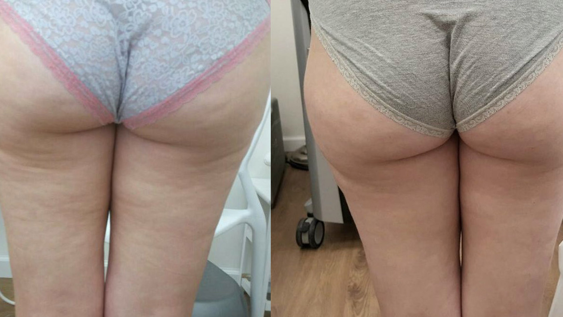 rezultatele tratamentului anticelulitic prin radiofrecventa multipolara viora v10 la episculpt beauty sibiu