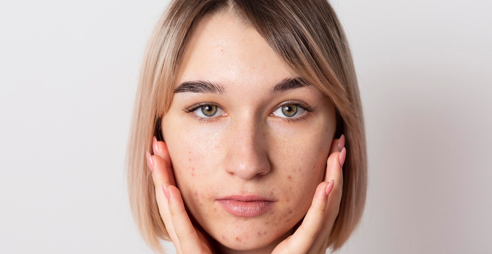 Tratament profesional pentru acnee cu radiofrecventa si Hydrafacial la Episculpt Beauty Sibiu