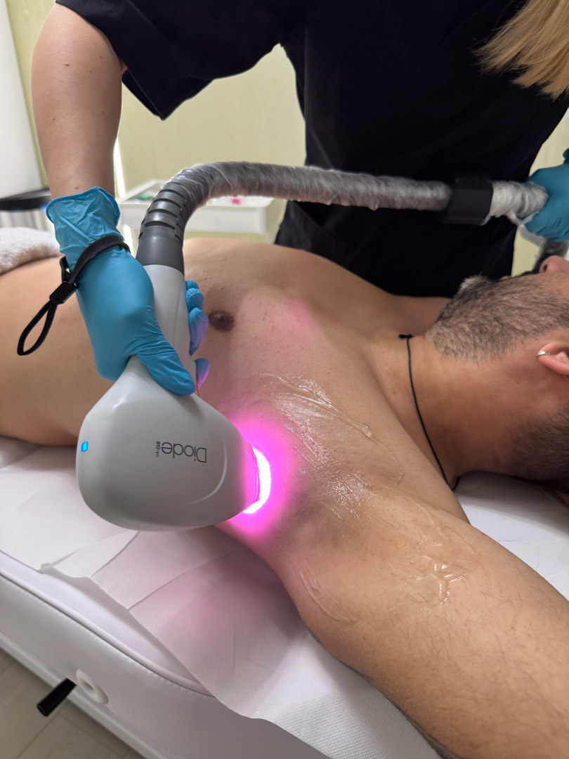 in timpul tratamentului de epilare definitiva cu laser a axilelor unui client la episculpt beauty