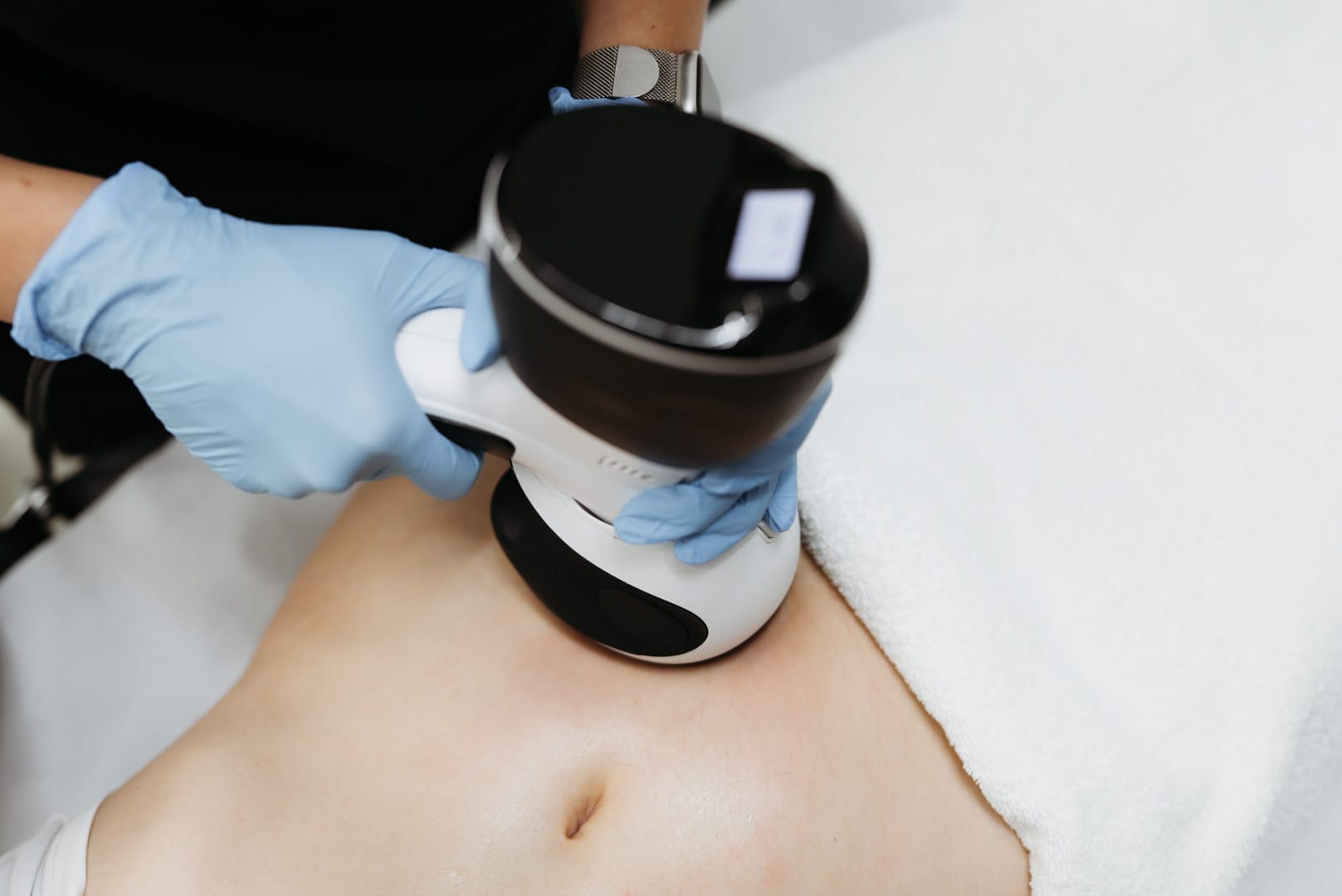 Aplicarea tratamentului cu Viora V10 pe zona abdomenului pentru reducerea laxitatei pielii la Episculpt Beauty Sibiu