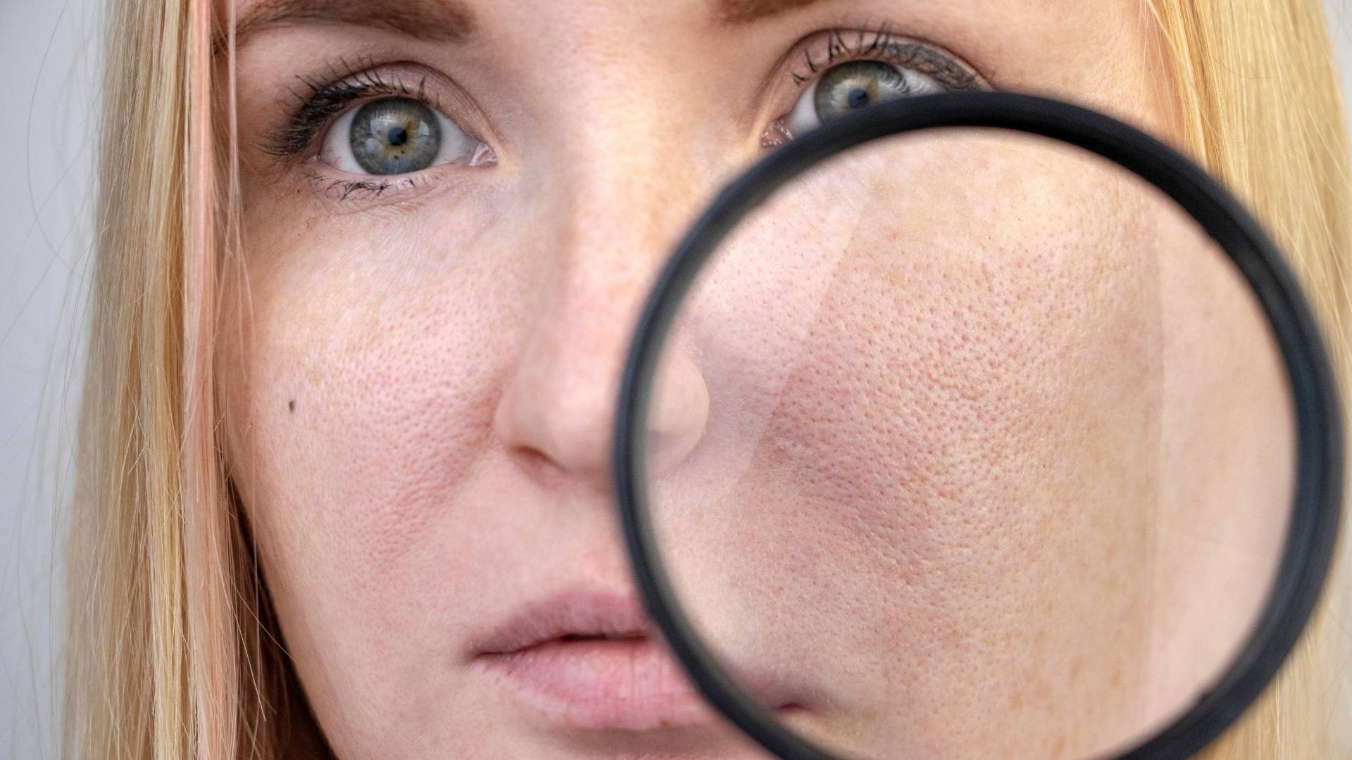 tratamente pentru reducerea porilor dilatati prin hidrodermabraziune Hydrafacial si radiofrecventa fractionata Viora V10 V-FR la episculpt beauty sibiu