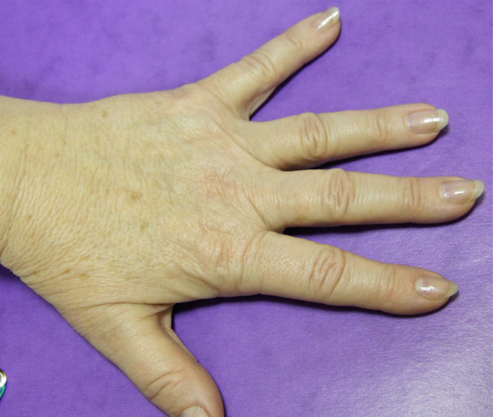 inainte de rejuvenare maini prin radiofrecventa