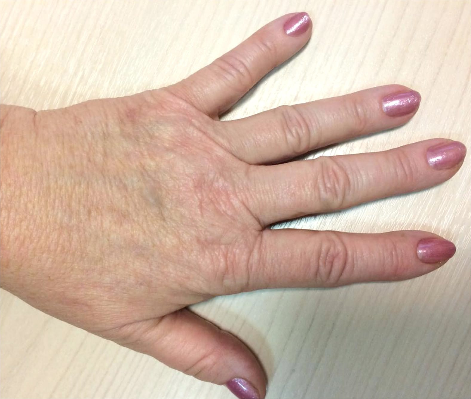 dupa aplicarea tratamentului de rejuvenare maini prin radiofrecventa