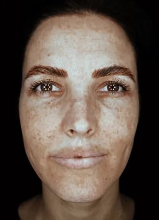 analiza si diagnoza pete pigmentare