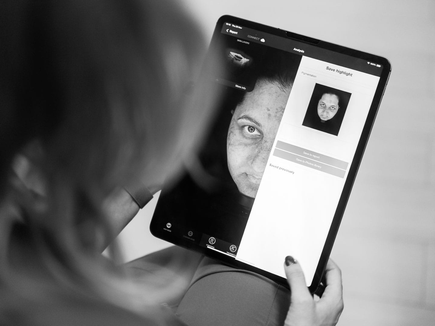 rezultat analiza si diagnoza faciala pacient cu pete pigmentare