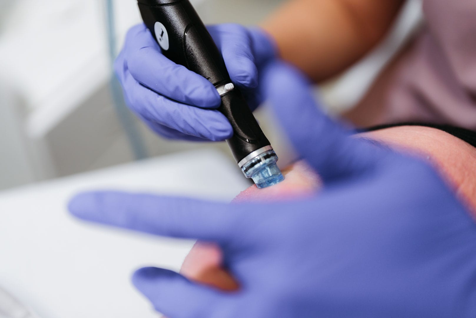 eliminarea punctelor negre si impuritatilor cu ajutorul tratamentului hydrafacial