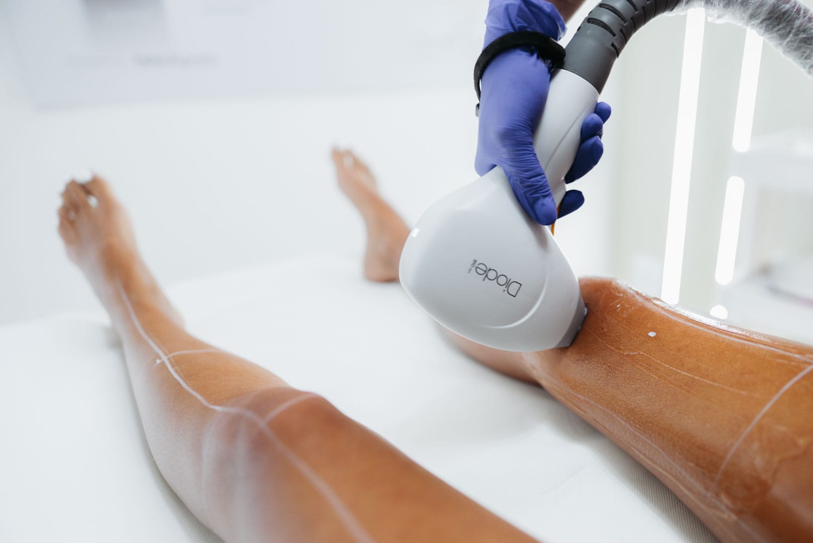 sedinta de epilare definitiva picioare cu laser dioda Primelase