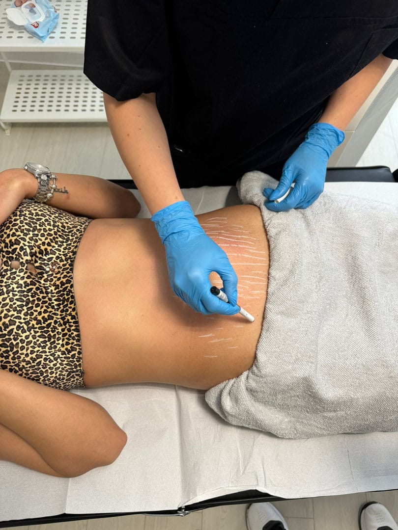 rejuvenarea pielii prin reducerea vergeturilor si cicatricilor la episculpt beauty