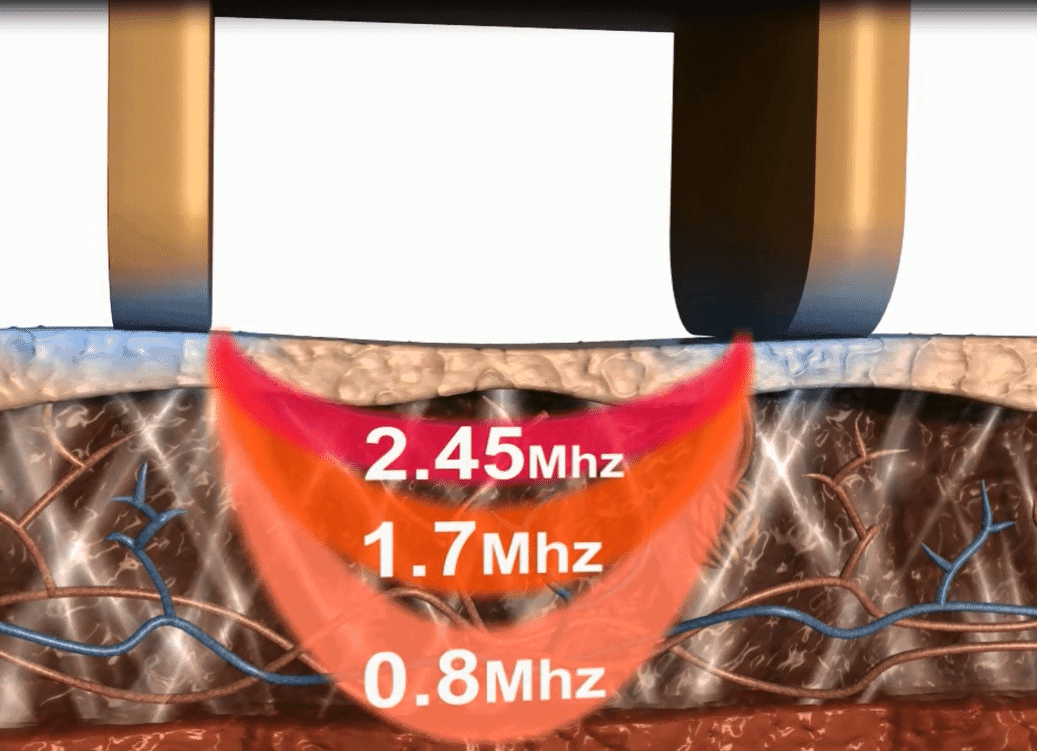 sectiune a pielii in care se prezinta cum actioneaza radiofrecventa bipolara asupra pielii