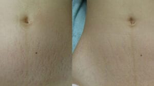 rezultat radiofrecventa corporala dupa 3 sedinte