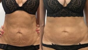 rezultat dupa 5 sedinte de radiofrecventa corporala pentru reducerea laxitatii la Episculpt Beauty Sibiu