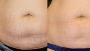 reducerea vergeturilor dupa tratamentul rejuvenare piele prin radiofrecventa la Episculpt Beauty