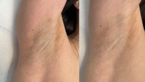 rezultat dupa 2 sedinte de epilare definitva laser