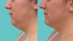 rezultat before and after criolipoliza gusa