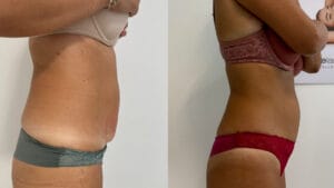rezultat before and after sedinta criolipoliza abdomen
