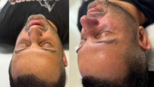 dupa o sedinta de tratament Hydrafacial la Episculpt Beauty Sibiu