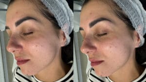 rezultat curatare puncte negre dupa Hydrafacial