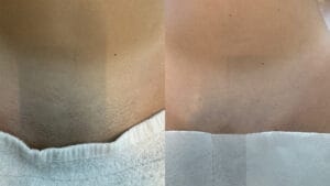 rezultat dupa 3 sedinte de epilare definitva laser in zona inghinala