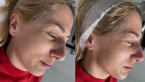 inainte si dupa Hydrafacial Sibiu