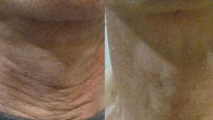 rezultat lifting piele gat prin radiofrecventa faciala - bipolara la Episculpt Beauty