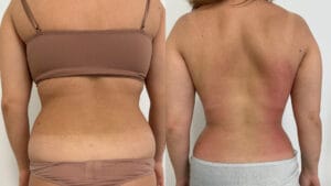 rezultat dupa 5 sedinte de radiofrecventa corporala