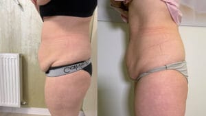 rezultat before and after tratament criolipoliza pentru reducerea tesutului adipos in zona abdominala