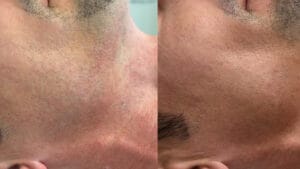 rezultat dupa 3 sedinte de epilare definitva laser obrajilor