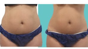 rezultat before and after sedinta criolipoliza