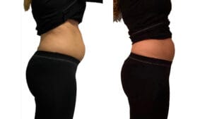 inainte si dupa electrostimulare la Episculpt Beauty