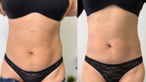 rezultat dupa 3 sedinte de radiofrecventa corporala