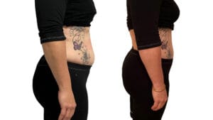 rezultat tonifere musculara prin electrostimulare la Episculpt