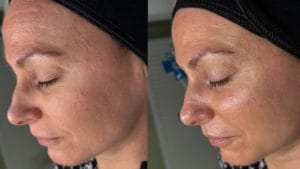 rezultat dupa tratamentul Hydrafacial la Episculpt Beauty Sibiu