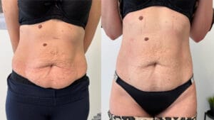 inainte si dupa radiofrecventa corporala la Episculpt Beauty Sibiu