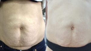 rezultat dupa 5 sedinte de radiofrecventa corporala cu viora v10 v-form la episculpt beauty