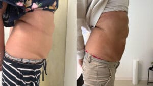 rezultat before and after criolipoliza sibiu