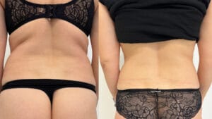 reducerea tesutului adipos si tonifierea pielii, rezultat obtinut dupa 3 sedinte de radiofrecventa corporala